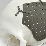 VISI’s Design Role In Unique Head Injury Prosthesis